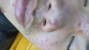 Успокаивающая экстракция акне и черных точек