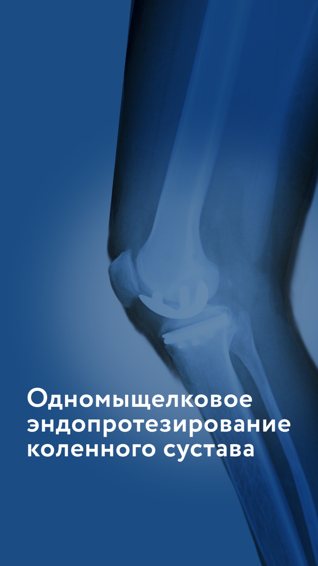 Одномыщелковое эндопротезирование коленного сустава