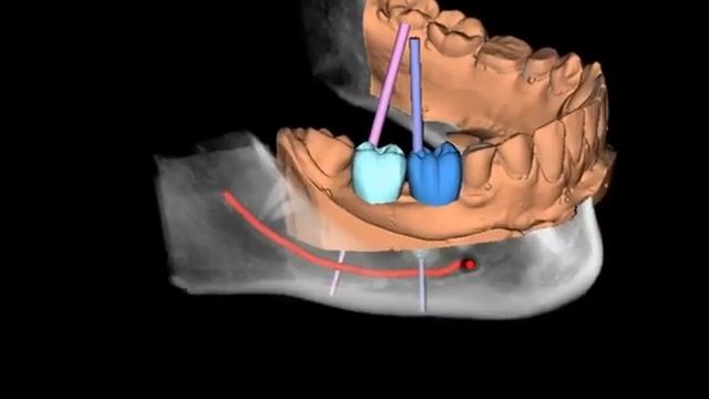 Дизайн-проект имплантации