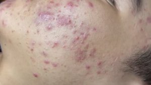 Взрывная чистка: удаление всего, что портит кожу