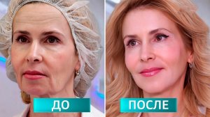 Брыли поплыли: в "Жить здорово!" рассказали о подтяжке лица без скальпеля