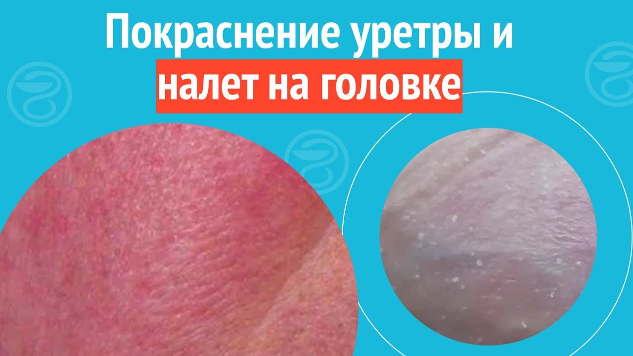 😡 Покраснение уретры и налет на головке. Клинический случай №1329 смотреть онлайн