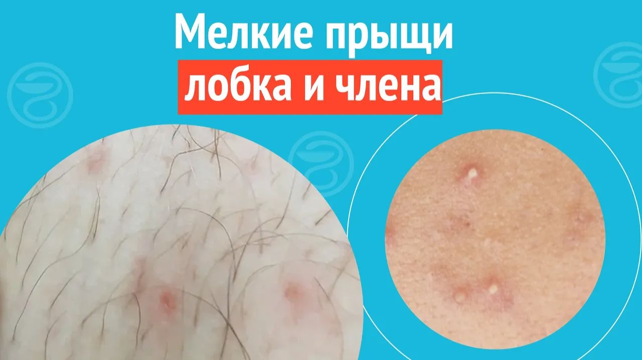 👉 Мелкие прыщи лобка и члена. Клинический случай №1325 смотреть онлайн