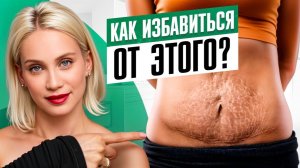 Растяжки! Что с ними делать? Самые эффективные и бесполезные метды