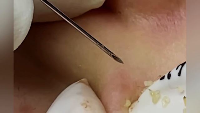 Выдавливание прыщей, угрей, черных точек и камедонов #336