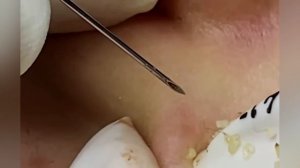 Выдавливание прыщей, угрей, черных точек и камедонов #336