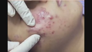 Удаление акне и черных точек, которые не чистили годами