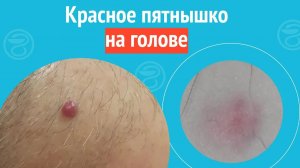 👨_🦲 Красное пятнышко на голове. Клинический случай №1330