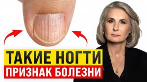 ДИАГНОСТИКА здоровья по ногтям! / Как БЫСТРО определить проблемы в организме?