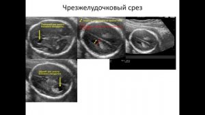 УЗИ головного мозга плода для педиатров