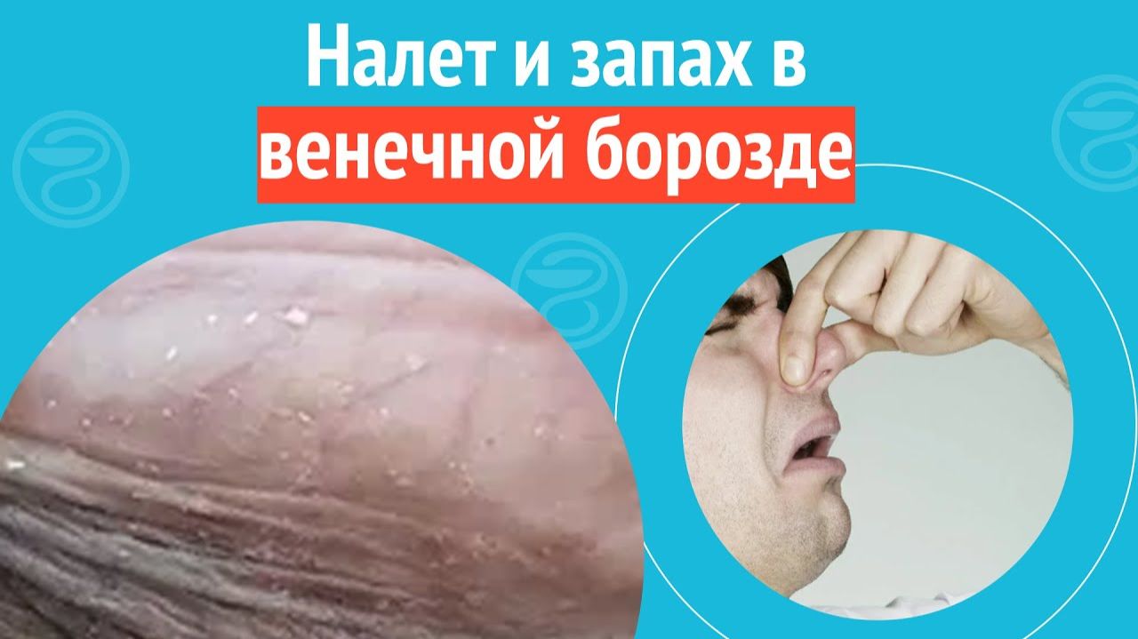 🤨 Налет и запах в венечной борозде. Клинический случай №1326 смотреть онлайн