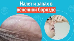 🤨 Налет и запах в венечной борозде. Клинический случай №1326