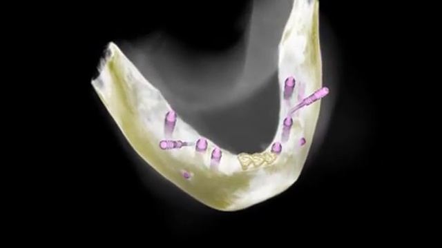 Дизайн проект имплантации при полном отсутствии зубов