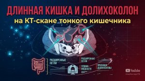 УДЛИНЕНИЕ кишечника, ДОЛИХОКОЛОН и дополнительные ПЕТЛИ КИШЕЧНИКА на РАСШИФРОВКЕ КТ энтерографии