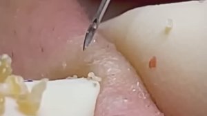 #240 Чистка лица от угрей и акне. Выдавливание прыщей. Удаление черных точек и комедонов