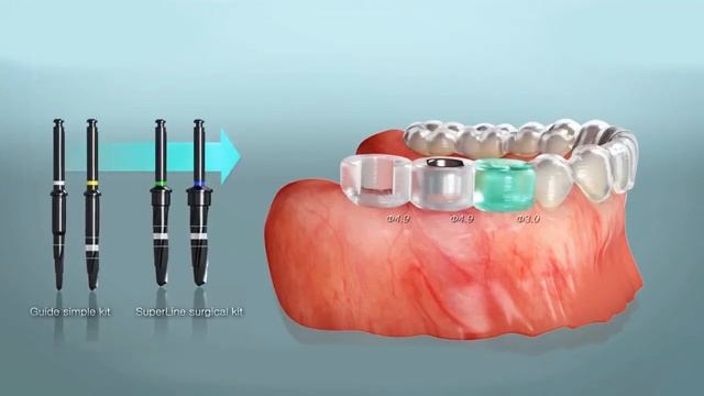Имплантация без разрезов и швов с использованием хирургического шаблона полного протокола