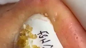 #239 Чистка лица от угрей и акне. Выдавливание прыщей. Удаление черных точек и комедонов