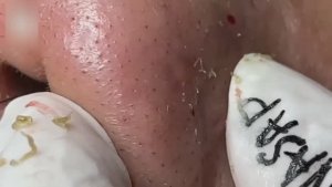 Механическая экстракция элементов акне и черных точек