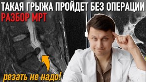 КАК ВЫГЛЯДИТ ГРЫЖА КОТОРАЯ ПРОЙДЕТ САМА: РАЗБОР МРТ