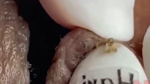 #242 Чистка лица от угрей и акне. Выдавливание прыщей. Удаление черных точек и комедонов