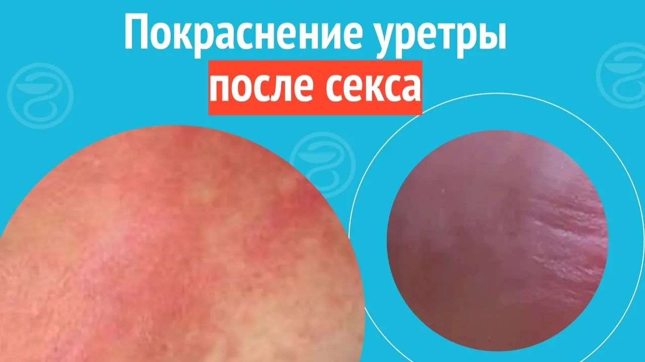 ☹️ Покраснение уретры после секса. Клинический случай №1347 смотреть онлайн