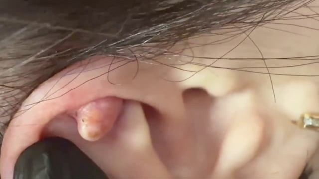 Новообразование на ушной раковине. Удаление