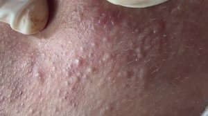 Вскрытие гигантских кистозных акне Часть 4