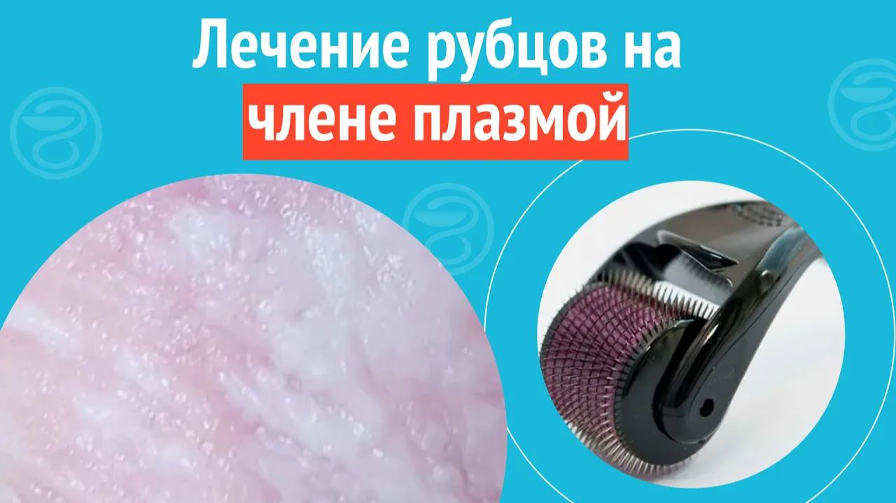 💉 Лечение рубцов на члене плазмой. Клинический случай №1339 смотреть онлайн