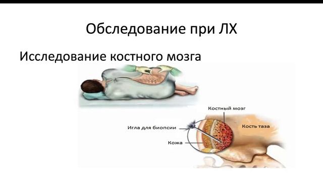 Мне установлен диагноз лимфомы Ходжкина. Как будет выглядеть лечение и какова его эффективность?