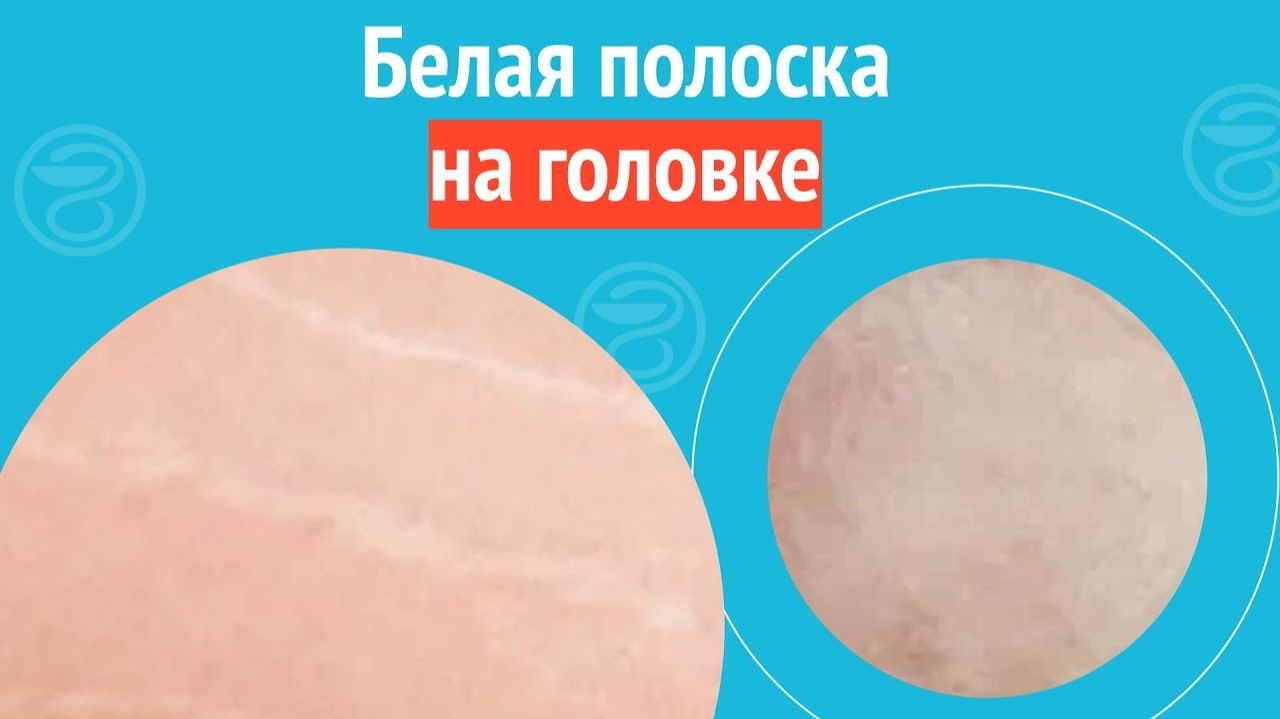 👀 Белая полоска на головке. Клинический случай №1344 смотреть онлайн