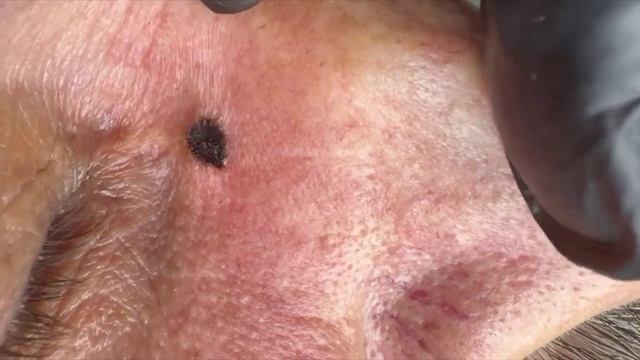 Новообразование на лице. Удаление