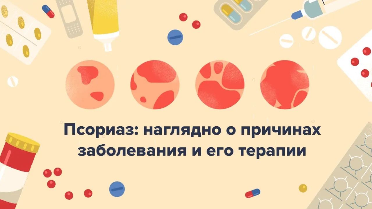 Все о псориазе: лечение, виды, профилактика