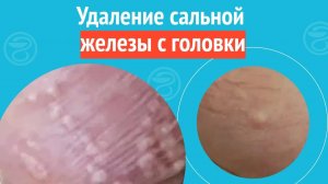 ✔️ Удаление сальной железы с головки. Клинический случай №1343