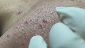 Вскрытие гигантских кистозных акне. Часть 3