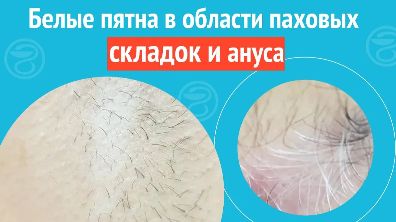 👉 Белые пятна в области паховых складок и ануса. Клинический случай №1341 смотреть онлайн