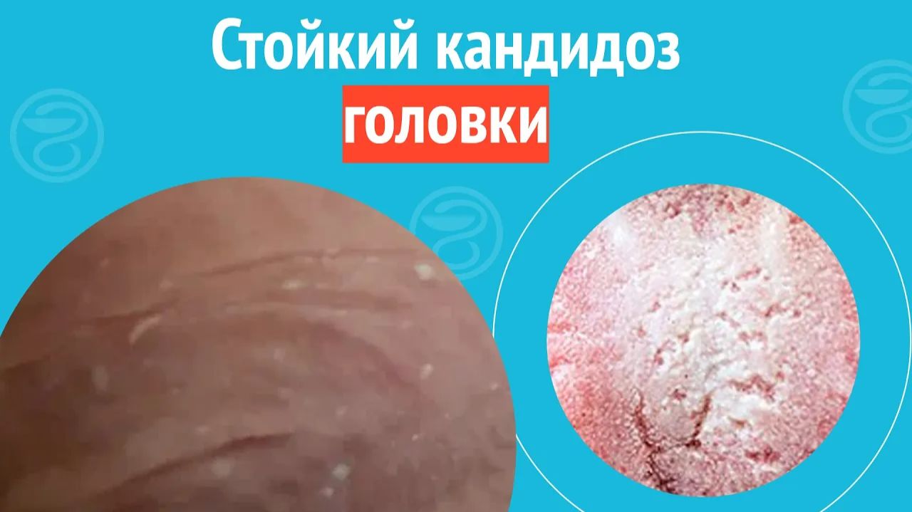 👉 Стойкий кандидоз головки. Клинический случай №1346 смотреть онлайн