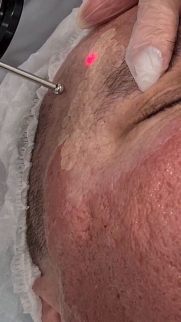 Лазерная шлифовка при постакне