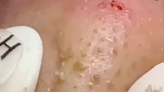 #243 Чистка лица от угрей и акне. Выдавливание прыщей. Удаление черных точек и комедонов