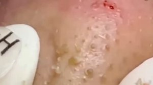 #243 Чистка лица от угрей и акне. Выдавливание прыщей. Удаление черных точек и комедонов