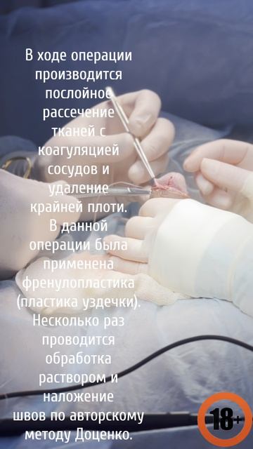 УРОЛОГИЯ: СТРОГО 18+ ОПЕРАЦИЯ ЦИРКУМЦИЗИО ПРИ ФИМОЗЕ. ПАЦИЕНТ 40+