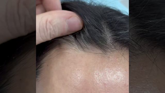 12 дней после операции эндоскопический лифт висков и средней зоны