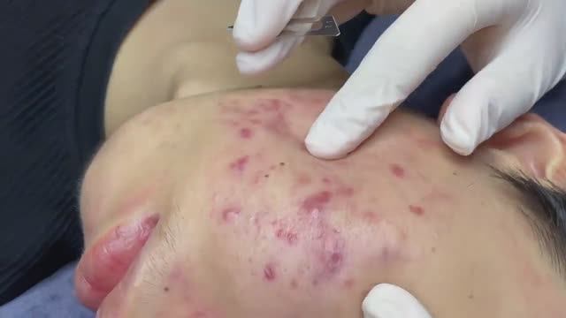 062 • Acne Collection • АСМР • Relax Spa