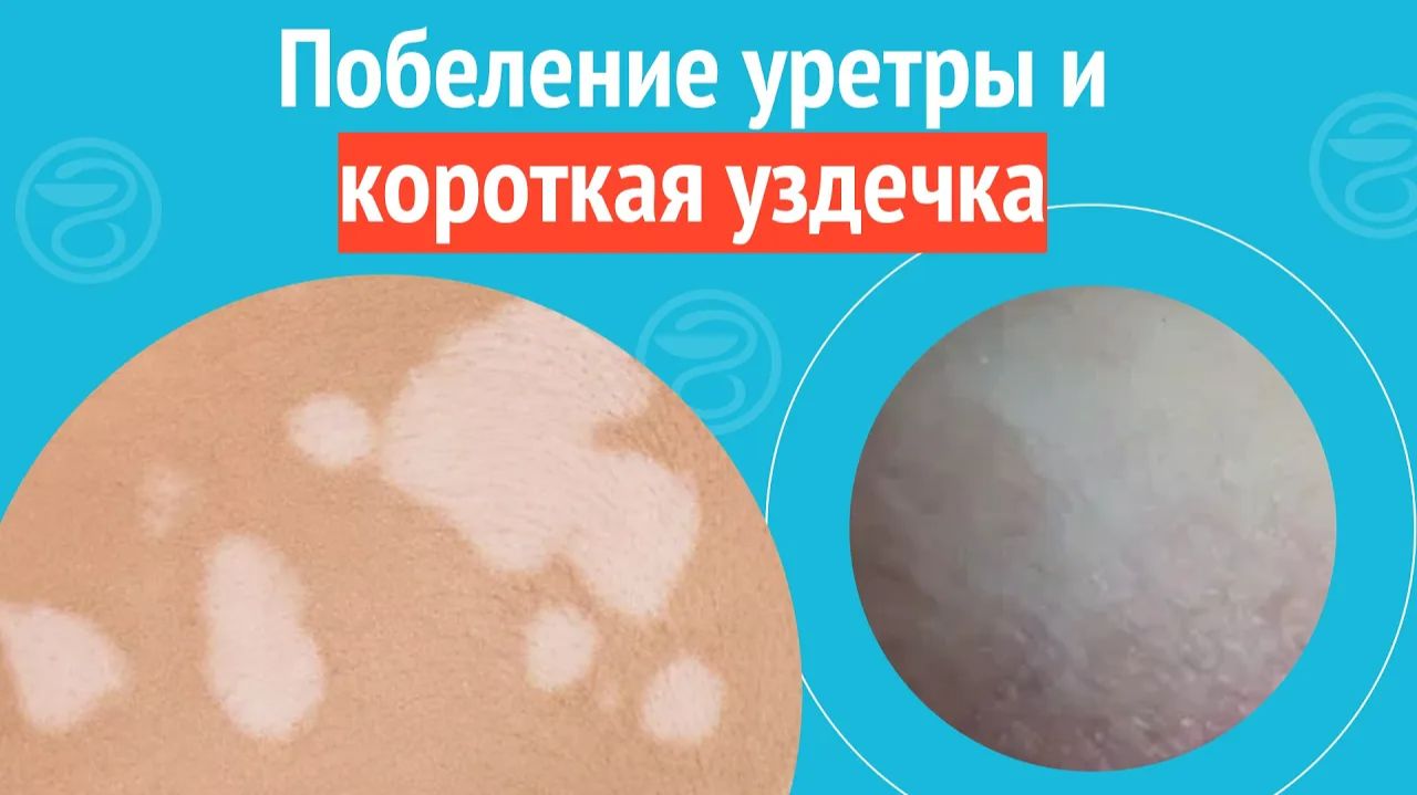 😨 Побеление уретры и короткая уздечка. Клинический случай №1353 смотреть онлайн