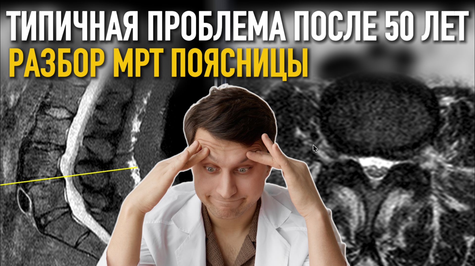 У ТАКИХ ЛЮДЕЙ СПИНА БУДЕТ БОЛЕТЬ ВСЕГДА: РАЗБОР МРТ