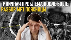 У ТАКИХ ЛЮДЕЙ СПИНА БУДЕТ БОЛЕТЬ ВСЕГДА: РАЗБОР МРТ