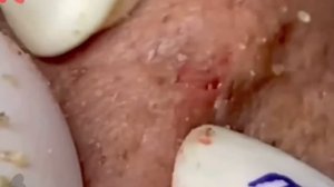 #241 Чистка лица от угрей и акне. Выдавливание прыщей. Удаление черных точек и комедонов