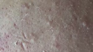 Вскрытие гигантских кистозных акне. Часть 2
