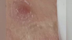 Выдавливание прыщей, угрей, черных точек и камедонов #341