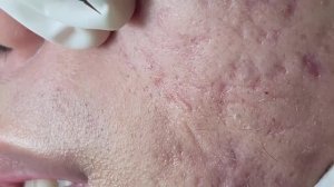 Экстракция комедонов и угрей. Без воды.