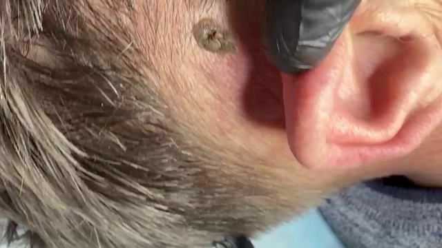 Удаляем новообразование за ухом